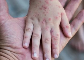 Dinkes Wonogiri Catat 28 Suspek Campak, Dua Kasus Terkonfirmasi pada Orang Dewasa